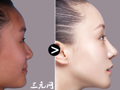 假体隆鼻,是怎么做的,会留疤吗