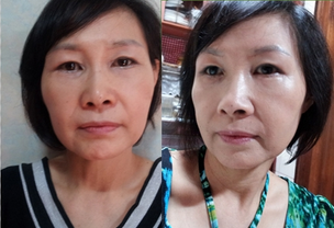 热玛吉紧致提升除皱恢复过程和前后对比效果图片