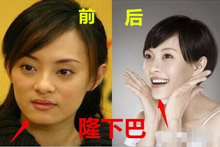 左侧是孙俪没有整容之前素颜的照片,右侧是垫下巴整容之后的照片三