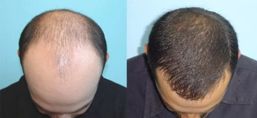 种植头发前后对比果图片和衡量标准