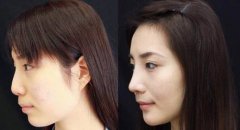 北京做硅胶隆鼻大概需要多少钱 北京做硅胶隆鼻大概需要多少钱