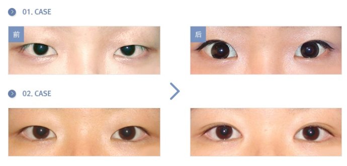 武汉亚太整形美容医院双眼皮案例图
