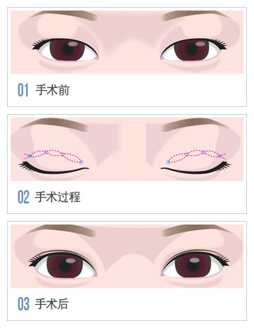 重庆天妃整形医院双眼皮价目表新出炉