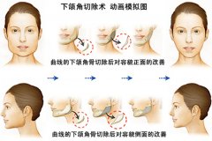 北京雅靓下颌角整形手术项目价格表