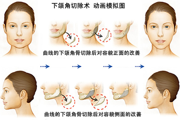【北京雅靓下颌角整形手术项目价格表】