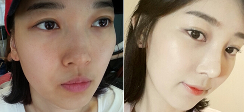 塌鼻子打玻尿酸隆鼻手术前后对比效果图片