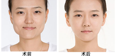 三元整形网 案例      下颌角整形全过程      终于从韩国回来了,而且