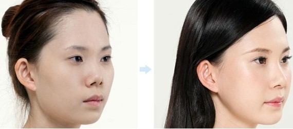 假体垫下巴前后对比效果图片和手术过程_三元整形网