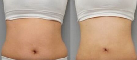 腰腹部吸脂贵不贵、腰腹吸脂需要多少钱