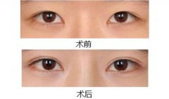 做了假体隆鼻后还能做埋线双眼皮吗