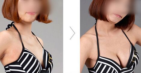 自体脂肪隆胸手感自然吗、手感真实吗