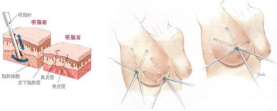 深圳鹏爱医疗美容医院价格表真实曝光