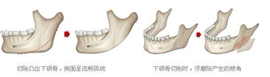 磨骨,瘦脸,术后,恢复,要多久