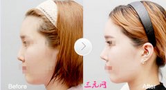 广州南珠整形美容隆鼻多少钱?哪个医生好? 广州南珠整形美容隆鼻多少钱?哪个医生好?