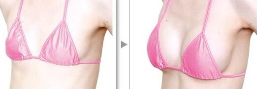 广州粤美整形美容医院隆胸价格表爆出