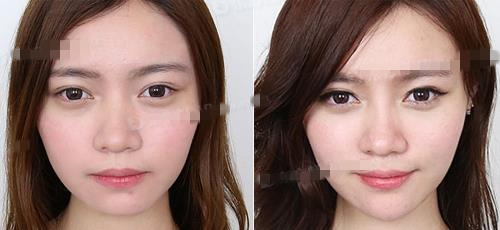 注射玻尿酸隆鼻前后对比效果图片和手术过程案例分享_三元整形网