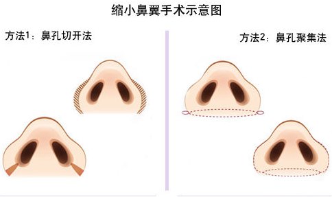 缩小,鼻翼,一般,多少钱
