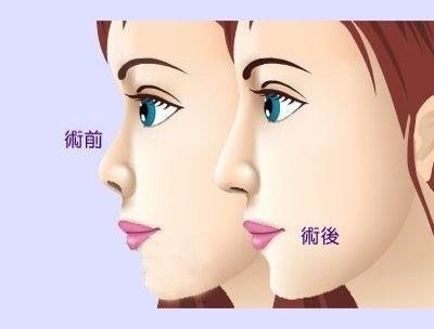 膨体,隆鼻,能保持,多久,一辈子