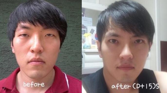 男生面部整形双眼皮隆鼻手术蜕变前后对比照片