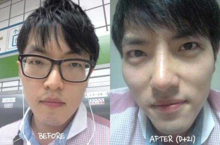男生面部整形双眼皮隆鼻手术蜕变前后对比照片