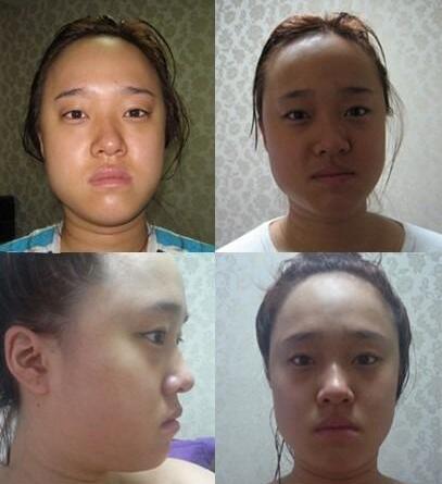 面部吸脂整形手术真实案例全新版前后对比照