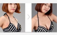 自体脂肪丰胸的优势有哪些 自体脂肪丰胸的优势有哪些