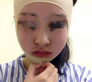 磨骨瘦脸手术前后对比效果图片和恢复过程_三元整形网