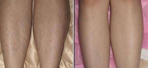 在深圳做脱毛多少钱、激光脱毛价格表新鲜出炉