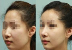 温州做假体隆鼻价格大概要多少钱 温州做假体隆鼻价格大概要多少钱