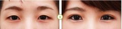 成都微创割双眼皮多少钱