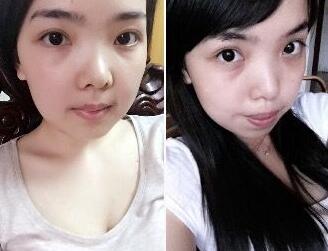 正颌 凸嘴矫正手术前后效果对比图和恢复过程