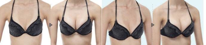 兰州假体隆胸需要多少钱、兰州假体隆胸价格表