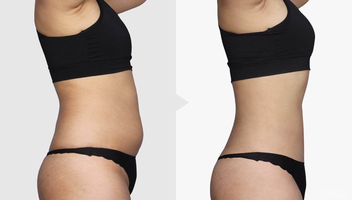 广州吸脂减肥费用贵吗、吸脂减肥多少钱