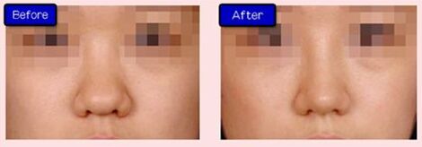 在广州做隆鼻手术一般多少钱、隆鼻整形价格表曝光