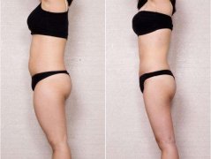 北京吸脂多少钱