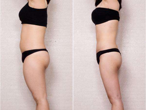 北京吸脂多少钱