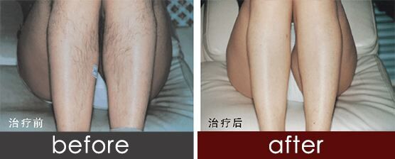 佛山激光脱毛大概多少钱、激光脱毛价格表曝出