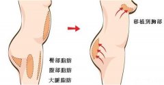 自体丰胸?这些需要注意! 自体丰胸?这些需要注意!