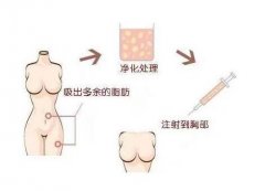 关于自体脂肪丰胸的注意事项,你知道多少 关于自体脂肪丰胸的注意事项,你知道多少