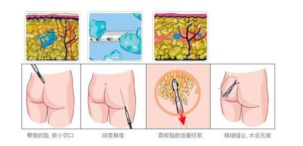 上海臀部抽脂减肥手术价格一览曝光