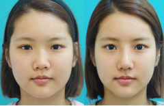 鼻翼收缩术大概多少钱 2017价格表及前后对比图 鼻翼收缩术大概多少钱 2017价格表及前后对比图