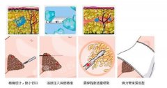小肚腩，不要怕!吸脂减肥来帮你!