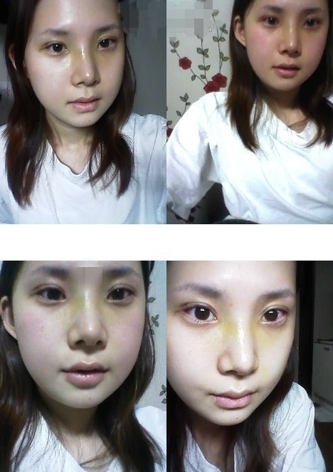 面部综合整形手术前后对比照片分享和恢复经历