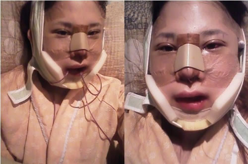 面部综合整形手术前后对比照片分享和恢复经历