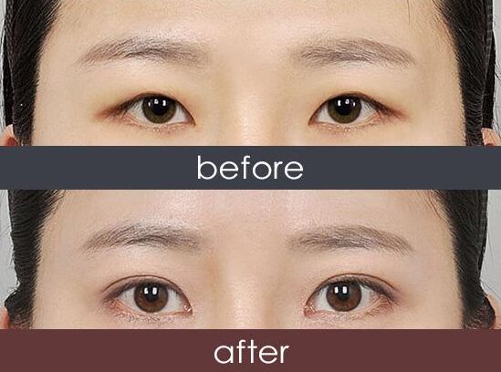上海三点双眼皮多少钱果怎么样