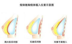 假体隆胸和自体脂肪隆胸哪种更好? 假体隆胸和自体脂肪隆胸哪种更好?