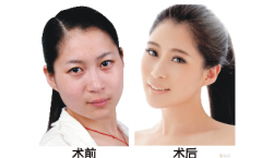 B****可以维持多久 国内全新B****价格表2017