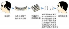 成都做毛发移植手术要多久时间能够恢复