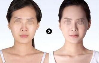 厦门隆鼻修复手术价格贵吗、隆鼻修复多少钱