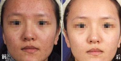 成都激光美容祛痘多少钱、激光美容祛痘的价格贵吗